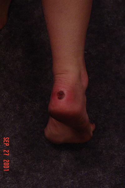 Kayte-s heel after hiking.JPG